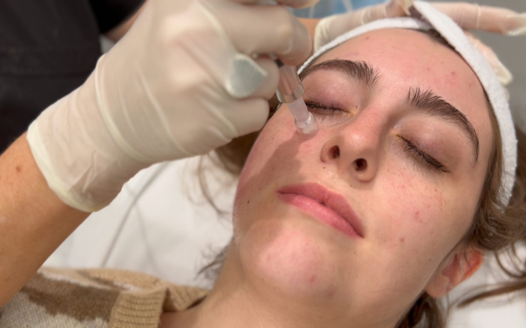 Look the Best with a Microneedling Treatment