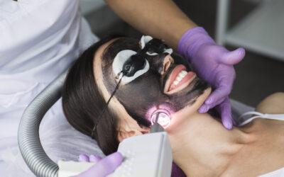 The Top Benefits of a Laser Carbon Facial