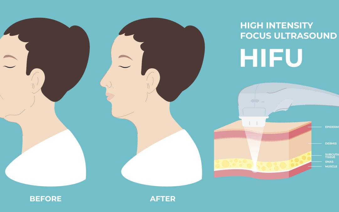 New Year, New You: HIFU Skin Tightening