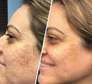 Rejuvenate Your Skin with RF Microneedling-before and after