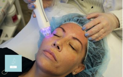 How Often Should You Get RF Microneedling? A Treatment Timeline
